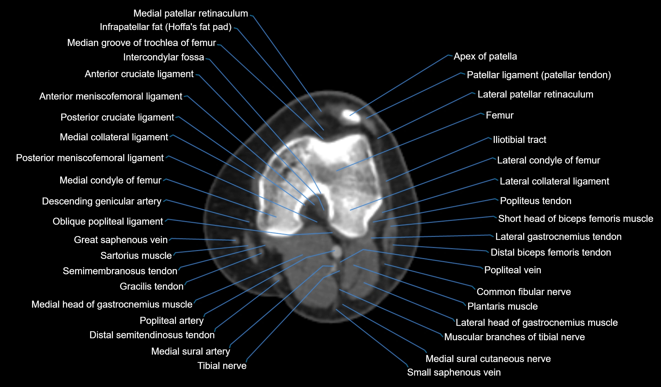 CT knee axial cross sectional anatomy labelled image-00030.webp
